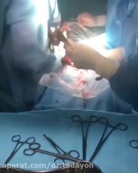 زایمان سزارین