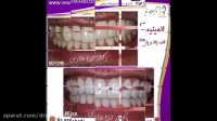 نمونه كارهای لمینت دندان | دکتر ندا هادی جراح و دندانپزشک زیبایی
