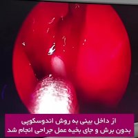 جراحی سینوزیت چرکی