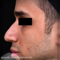 نمونه جراحی زیبایی بینی