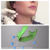 تزریق فیلر برای فرم صورت و زاویه سازی فک