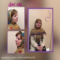 نمونه کار جراحی بینی