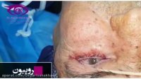 فلیم واقعی جراحی انتروپیون(برگشتن پلک به سمت داخل)