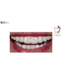 درمان زیبایی فک پایین با تر کیب روکش زیبایی و لامینیت سرامیکی