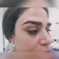 فیلم کاشت ابرو _کلینیک فوق تخصصی رنسانس