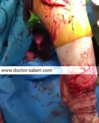 انتهای عمل تعویض مفصل زانو