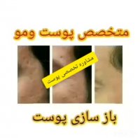 کرم درمانی جوانساز لازان درمان قطعی جای جوش و جوش های صورت