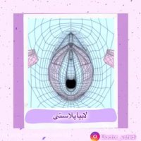 انیمیشنی از چگونگی لابیاپلاستی