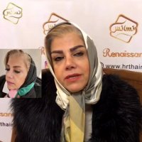 فیلم کاشت ابرو -کلینیک تخصصی رنسانس