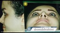 جراحی بینی ترمیمی توسط دکتر امید ابراهیمی بهترین جراح