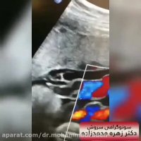 سونوگرافی کالرداپلر بند ناف جنین
