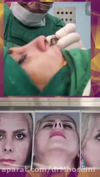 نمونه ای از جراحی بینی ترمیمی
