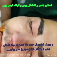 فیلم جراحی ترمیم بینی