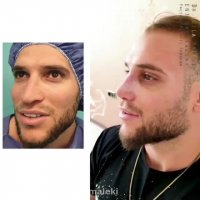 ده روز پس از جراحی بینی