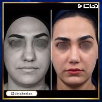 نمونه کار جراحی بینی