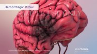 Your Risk of Stroke