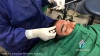 فیلم لیفت ابرو در حین جراحی