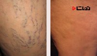 درمان واریس از نزدیک