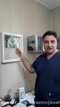 دکمپرشن سر استخوان ران در مراحل ابتدایی سیاه شدگی