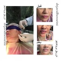 جوانسازی صورت با تزریق فیلر