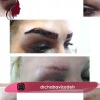 فیلم واقعی کاشت ابرو