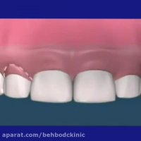 پرکردن فاصله دندان ها با استفاده از ونیر ساخته شده در لابراتور