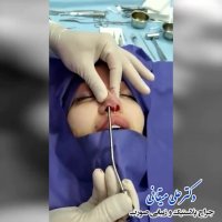 فیلم تخلیه ژل بینی و بازسازی با غضروف بینی