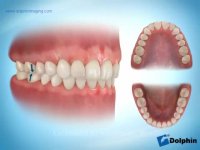 درمان ارتودنسی دیپ بایت | دکتر مسعود داوودیان