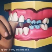 تاثیر مکیدن انگشت بر سلامت دهان و دندان کودک