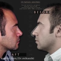 فیلم جراحی بینی مردانه و تغییرات جالب