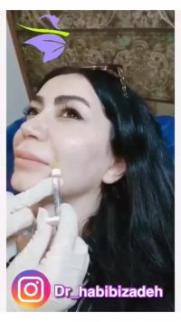 فیلم بوتاکس خط خنده