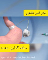 حلقه گذاری معده