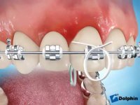 دکتر مسعود داودیان :: نحوه کشیدن نخ دندان ارتودنسی