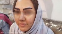 بهترین روش کاشت ابروی طبیعی