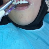 فیلم کامپوزیت ونیر دندان توسط دکتر فرزانه فرخ نژاد