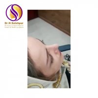 رینوپلاستی