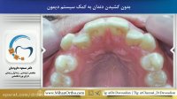 قبل و بعد ارتودنسی دیمون | دکتر مسعود داوودیان