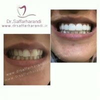 تغییر رنگ همراه با برطرف کردن بهم ریختگی