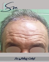 نمونه عمل لیفت پیشانی به روش باز