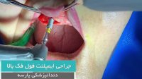 جراحی ایمپلنت فک بالا