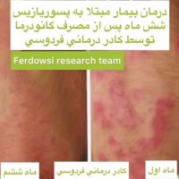 پسوریازیس درمان قطعی دارد؟