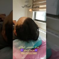 اسکالپ سر برای آقایانی که کاشت مو انجام میدهند