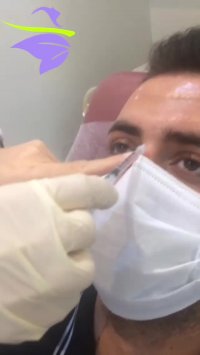 فیلم تزریق بوتاکس به پیشانی