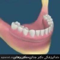 جلوگیری از ازدست رفتن دندان با جراحی لثه