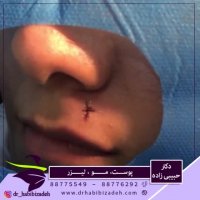 فیلم برداشتن خال گوشتی ریشه دار