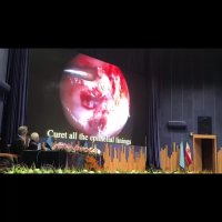 جراحی آندوسکوپی تومور حدقه و مغز از راه حدقه | پروفسور کشکولی