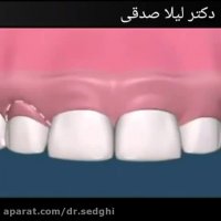 افزایش طول تاج دندان