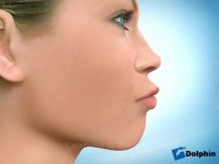 ارتودنسی بیرون زدگی لب ها | دکتر مسعود داوودیان