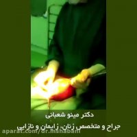 خارج کردن رحم به دلیل وجود میوم بزرگ و خونریزی های شدید