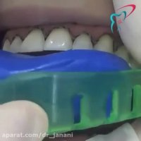 قرار دادن نخ زیر لثه برای قالب گیری